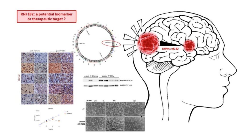 Tumore cerebrale, Neuromed: proteina implicata nei meccanismi di regolazione cellulare può favorirne proliferazione